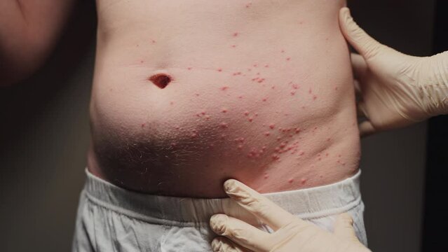 Carefully examines the abdominal belly region of a man, revealing a multitude of bumps that are most likely the result of an allergic reaction triggered by insect bites.