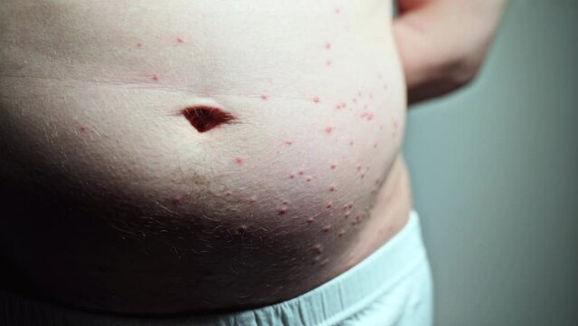 Close-up of the man's stomach with belly button, a few bumps are visible nearby.