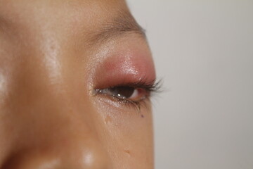 swollen eye pain in children
