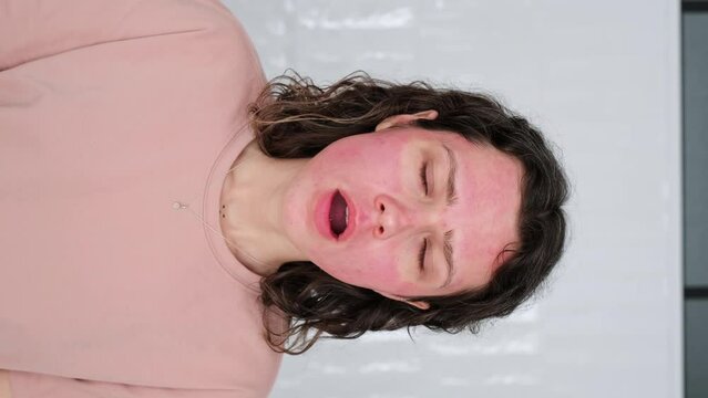 Vertical video. Close up portrait of young woman in shock due to burns on face after unsuccessful beauty treatments. Skin after failed chemical peel. DIY Home care mistakes. Face after Dermapen. 9x16