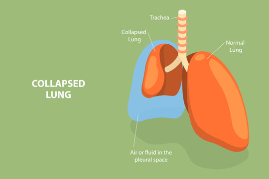3D Isometric Flat Vector Conceptual Illustration of Collapsed Lung, Respiratory System Issue