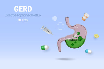 GERD gastroesophageal reflux acid on stomach. Digestive disorder causes patient heartburn pain or acid reflux indigestion. Medical and healthcare. 3D vector.