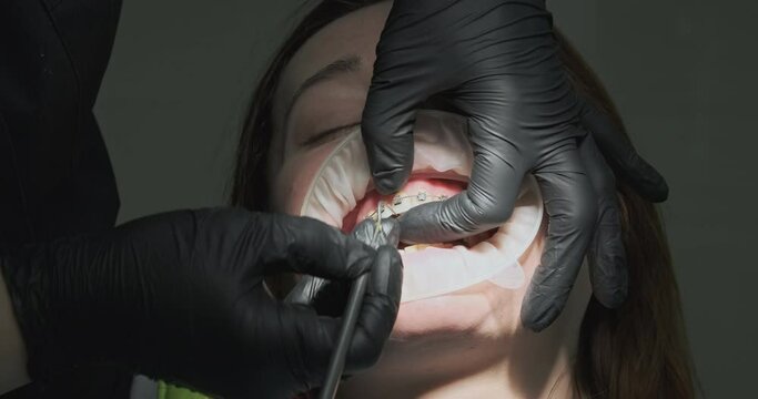 Orthodontist snaps off the locks on the braces to remove them from the patient's teeth.