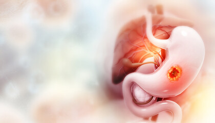 Stomach cancer, gastric cancer, symptoms, stages, treatment, 3d illustration