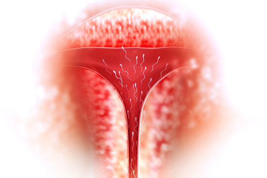 Intra-uterine Insemination treatment. 3d illustration