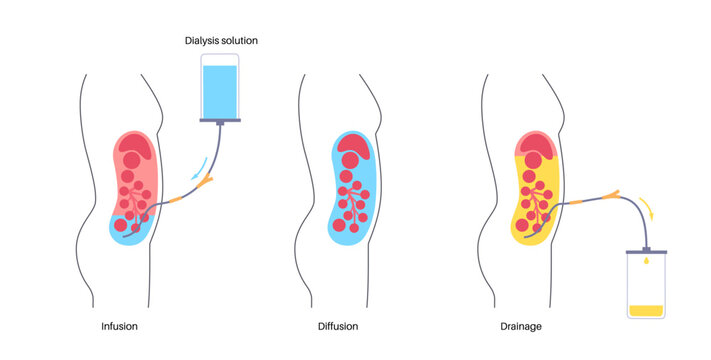 Peritoneal dialysis concept