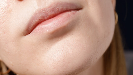 Beautiful young girl with acne and scars on her chin. Closeup.