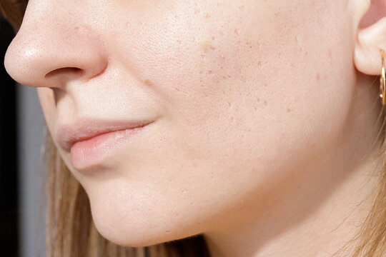 Young woman suffering from problem skin and acne closeup. Icepick scars acne on cheek