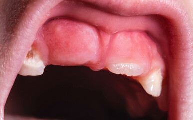 The eruption of a permanent tooth after the loss of a milk tooth in a child, close-up. Children's...