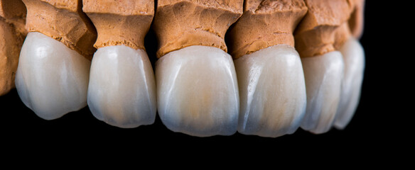 emax crowns on teeth and implants