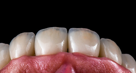 Fototapeta na wymiar emax crowns on teeth and implants