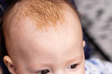 Milk crusts on the head of a newborn child, gneiss. The formation of yellow-golden scales on the head of an infant, close-up
