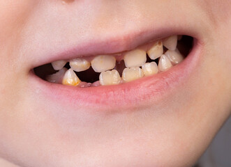 Obraz premium Mouth and smile of a child without one tooth. Loss of milk teeth in children, close-up
