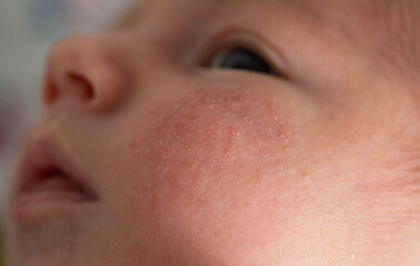 Rash on the face of a newborn baby. The process of formation of the hormonal system, close-up