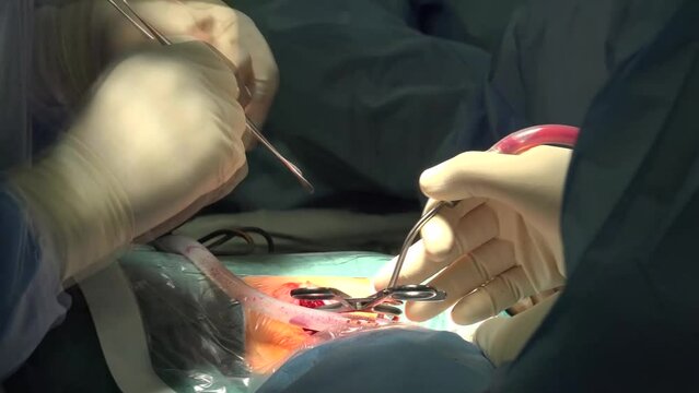 Spine Surgery and Spinal Fusion