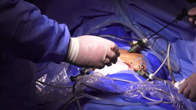 Laparoscopic Surgery performed in the hospital