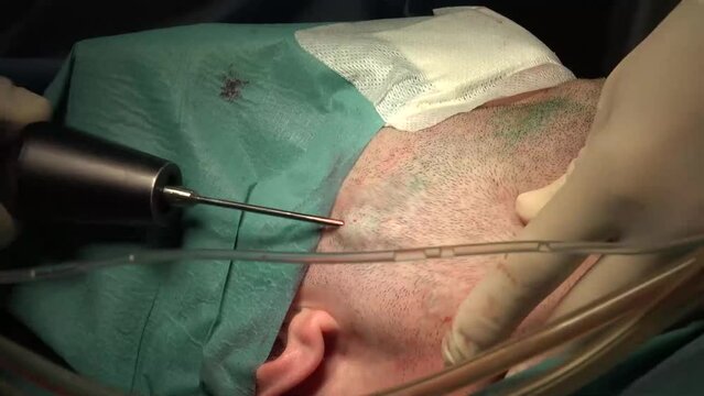 A Graphic video of Facial Liposuction