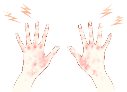 手の甲の赤み　手荒れ