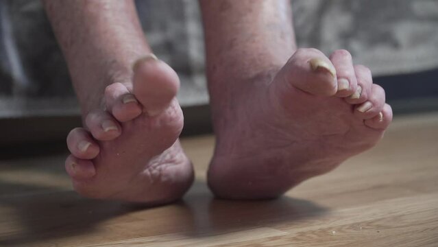 Patients legs of an old woman. Varicose veins on a female legs. Phlebology. Feet of an old woman with mutilated sick nails. Close up varicose veins on the leg. The old woman unkempt toenails.