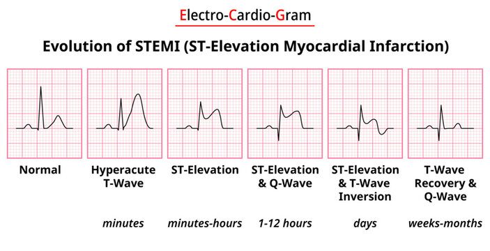 Evolution of STEMI (ST-Elecation Myocardial Infarction) - Electrocardiogram Medical Vector Illustration