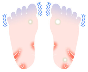不健康な足裏のイラスト