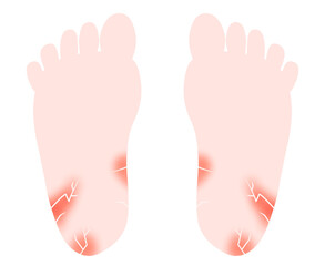 傷・亀裂のある足裏のイラスト