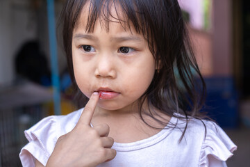  A little girl Asian pointing her finger to her mouth, wounds on her lips feels pain, bleeding,...