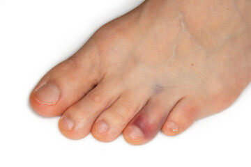 Close up of a broken toe - a common injury that's most often caused by dropping something on a foot...