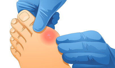 Bump on the leg. Foot with gout. Hallux valgus. Healthcare illustration. Vector illustration