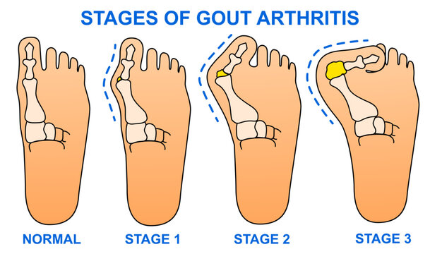 Stages of gout arthritis. Bump on the leg. Foot with gout. Hallux valgus. Healthcare illustration. Vector illustration