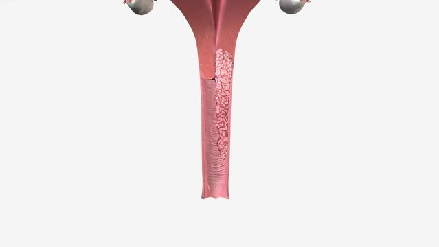 Stage 3 means the cancer has spread away from the cervix and into surrounding structures in the pelvis (the area between the hip bones)