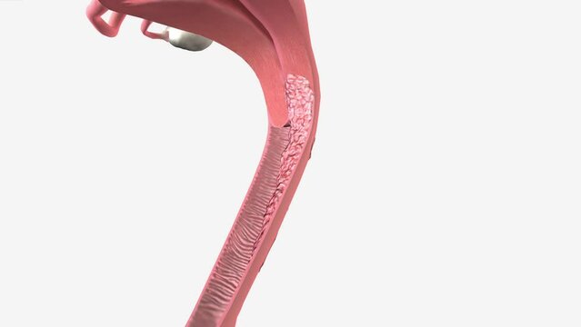 Stage 3 means the cancer has spread away from the cervix and into surrounding structures in the pelvis (the area between the hip bones)