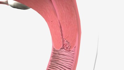 Stage I: The cancer has spread from the cervix lining into the deeper tissue but is still just found in the uterus