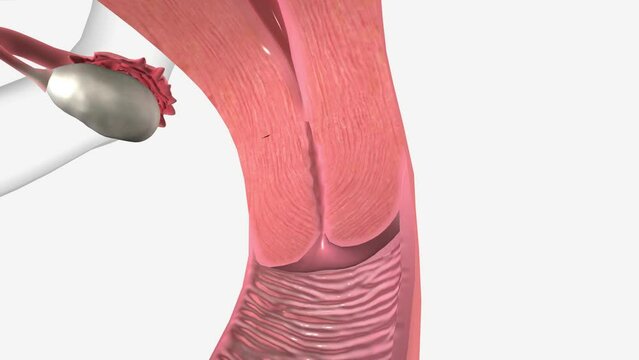 Cervical cancer is a type of cancer that occurs in the cells of the cervix