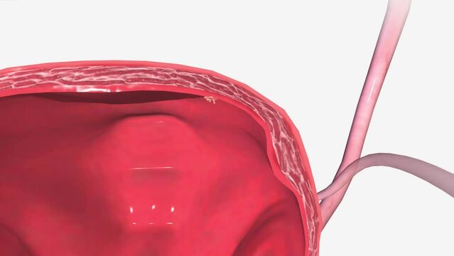 Stage 0 bladder cancer refers to noninvasive bladder cancer