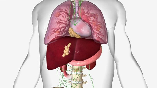 Stage 4 oesophageal cancer means your cancer is advanced. Your cancer might have spread into other organs or body structures next to the oesophagus