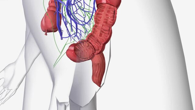 Stage II colorectal cancer is divided into stages IIA, IIB, and IIC. In stage IIA, cancer has spread through the muscle layer of the colon and or rectum