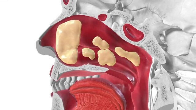 Common Cold Symptoms, Inflamed nasal cavity