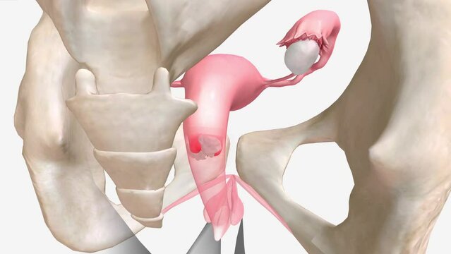 Pelvic inflammatory disease is an infection of a woman's reproductive organs