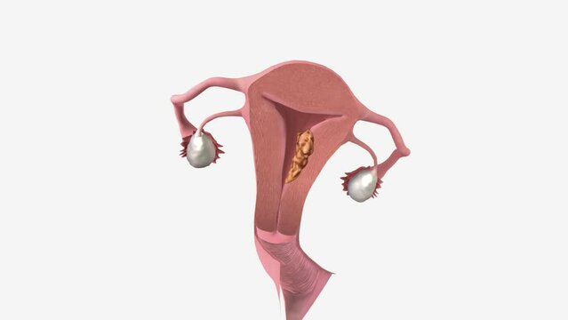 Stage II endometrial cancer shown in a cross-section drawing of the uterus, cervix Stage II endometrial cancer