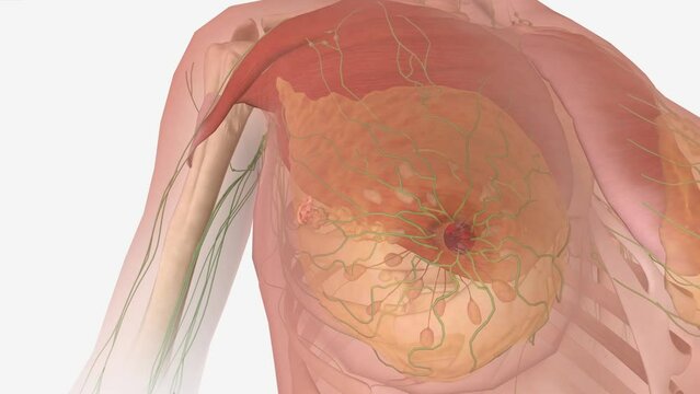 Stage III Breast Cancer