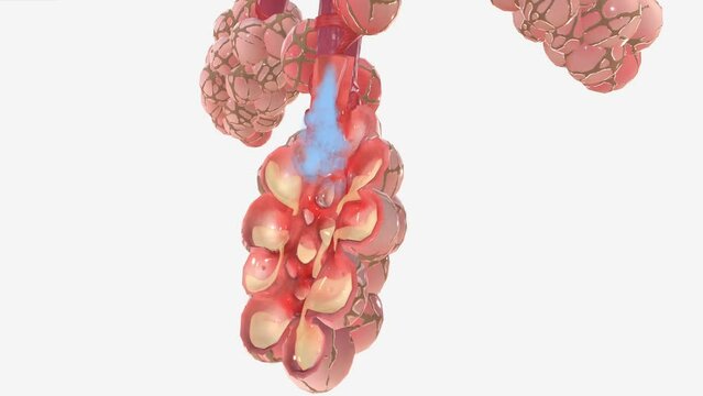 Acute Respiratory Distress Syndrome ARDS