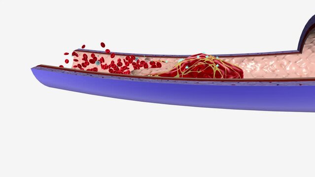 A blood clot in a deep vein of the leg, pelvis, and sometimes arm, is called deep vein thrombosis