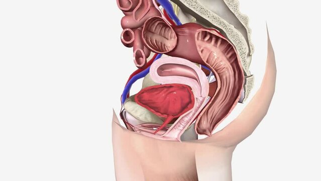 cystocele Grade 1 is the mildest form of the condition, and grades 3 and 4 are the most serious.