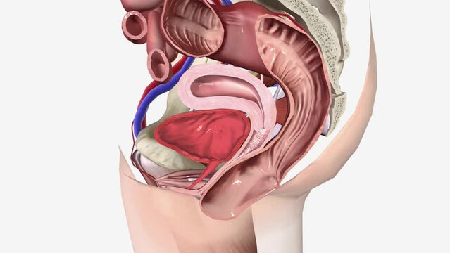 A rectocele is when the rectum protrudes into the vagina.