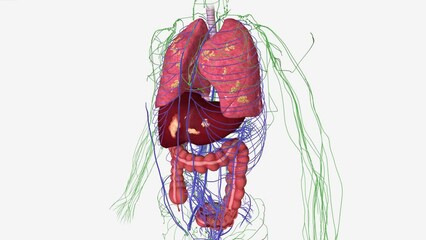 Stage 4 colon cancer is the most serious and advanced stage. It means the cancer has spread outside of the colon to other parts of the body