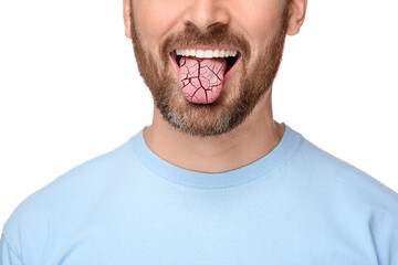Dry mouth symptom. Man showing dehydrated tongue on white background, closeup - obrazy, fototapety, plakaty