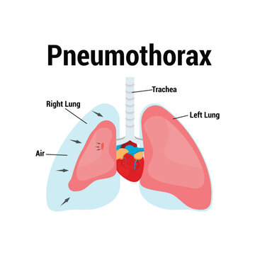 symptoms of pneumothorax lung vector
