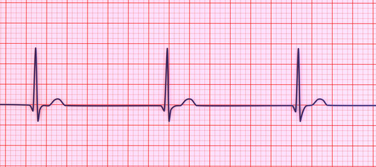 Electrocardiogram ECG displaying a junctional rhythm, 3D illustration