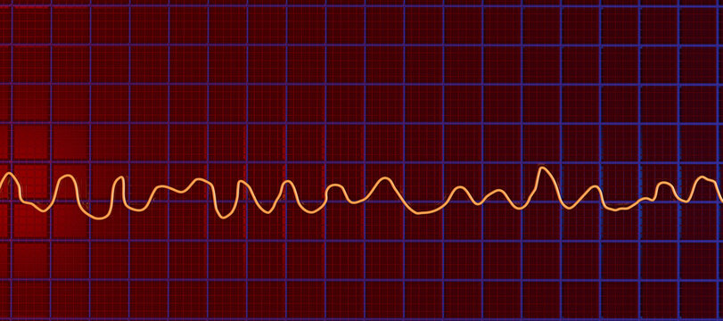 Electrocardiogram ECG displaying ventricular fibrillation rhythm, 3D illustration